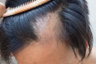 An osteoporosis Tx may promote hair growth to the same magnitude as CsA (if not better), and without its side effects. An osteoporosis Tx may promote hair growth to the same magnitude as CsA (if not better), and without its side effects.