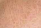 Skin Autofluorescence Predicts T2DM, Heart Disease, Mortality Skin Autofluorescence Predicts T2DM, Heart Disease, Mortality