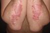 Guselkumab Compared With Secukinumab in Head-to-Head Plaque Psoriasis Trial Guselkumab Compared With Secukinumab in Head-to-Head Plaque Psoriasis Trial