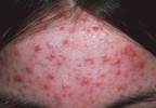 Low Glycemic Index/Glycemic Load Decreases IGF-1 Levels in Adults With Acne Low Glycemic Index/Glycemic Load Decreases IGF-1 Levels in Adults With Acne