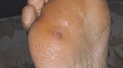Microneedling Plus Bleomycin Spraying Superior for Plantar Wart Treatment Microneedling Plus Bleomycin Spraying Superior for Plantar Wart Treatment