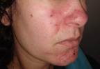 The Psychosocial Impact of Rosacea: Should Clinicians Be Concerned? The Psychosocial Impact of Rosacea: Should Clinicians Be Concerned?