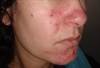 The Psychosocial Impact of Rosacea: Should Clinicians Be Concerned? The Psychosocial Impact of Rosacea: Should Clinicians Be Concerned?
