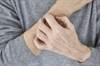 Treating Chronic Itch: Therapeutic Review Treating Chronic Itch: Therapeutic Review