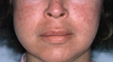 Severe Rosacea Associated With High Out-of-Pocket Treatment Costs Severe Rosacea Associated With High Out-of-Pocket Treatment Costs