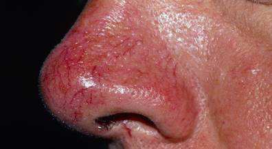 Topical and Systemic Treatments for Rosacea-Associated Erythema: Weighing Your Options Topical and Systemic Treatments for Rosacea-Associated Erythema: Weighing Your Options