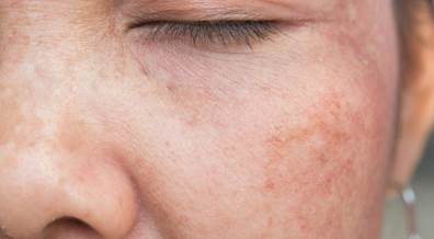 Facial Morphing Program May Deter Young Adults From Tanning Facial Morphing Program May Deter Young Adults From Tanning