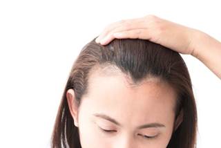 Primary study outcomes were the development of alopecia areata in the cohort exposed to depression and the development of major depressive disorder in the cohort exposed to alopecia.