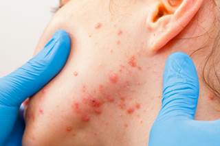 The opportunity exists for pediatricians to treat their patients with acne more effectively. The opportunity exists for pediatricians to treat their patients with acne more effectively.
