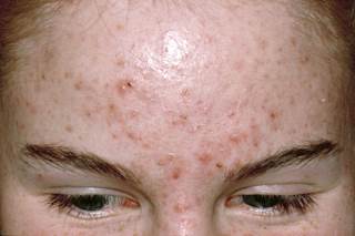 HAAT is being recognized as a promising therapy in women with acne. HAAT is being recognized as a promising therapy in women with acne.