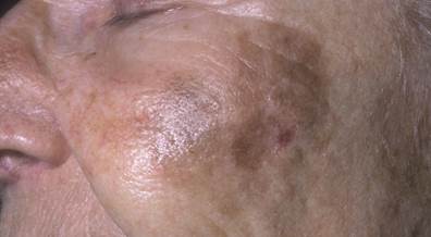 Imiquimod Cream Reduces Margins for Lentigo Maligna Excision Imiquimod Cream Reduces Margins for Lentigo Maligna Excision