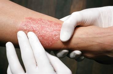 Psoriasis Treatment With Biologics Often Requires Multiple Courses, Treatment Changes Psoriasis Treatment With Biologics Often Requires Multiple Courses, Treatment Changes
