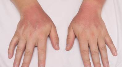 Decision Tree Model Can ID Behaviors Linked to Sunburn Risk Decision Tree Model Can ID Behaviors Linked to Sunburn Risk
