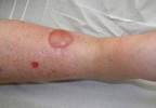 Link Between Bullous Pemphigoid and Dipeptidyl Peptidase-4 Inhibitors Link Between Bullous Pemphigoid and Dipeptidyl Peptidase-4 Inhibitors