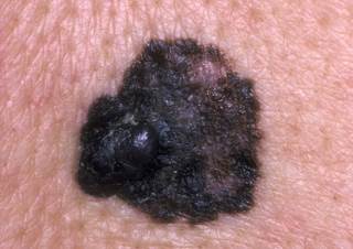 The investigators sought to explore the role of MC1R variants in risk for melanoma in men and women separately. The investigators sought to explore the role of MC1R variants in risk for melanoma in men and women separately.