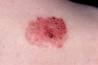 Given the inherent risks associated with chemoprophylaxis, the need for prophylactic anticoagulation in patients with KC undergoing surgery should be considered. Given the inherent risks associated with chemoprophylaxis, the need for prophylactic anticoagulation in patients with KC undergoing surgery should be considered.