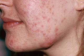 Researchers assessed overall aesthetic appearance, acne lesions, and acne scars in patients with mild to moderate acne to determine improvement with Er:Glass laser therapy. Researchers assessed overall aesthetic appearance, acne lesions, and acne scars in patients with mild to moderate acne to determine improvement with Er:Glass laser therapy.