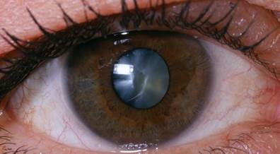 Pediatric Atopic Dermatitis Associated With Cataract Development Pediatric Atopic Dermatitis Associated With Cataract Development