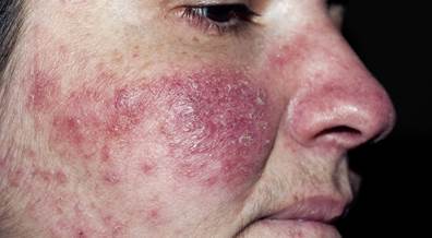 Patch Testing Beneficial in Rosacea to Detect Contact Sensitivity Patch Testing Beneficial in Rosacea to Detect Contact Sensitivity