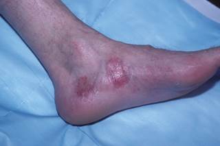 Results showed an overall pooled prevalence of 19.7% of psoriatic arthritis in patients with psoriasis and 24.6% in patients with moderate to severe disease. Results showed an overall pooled prevalence of 19.7% of psoriatic arthritis in patients with psoriasis and 24.6% in patients with moderate to severe disease.