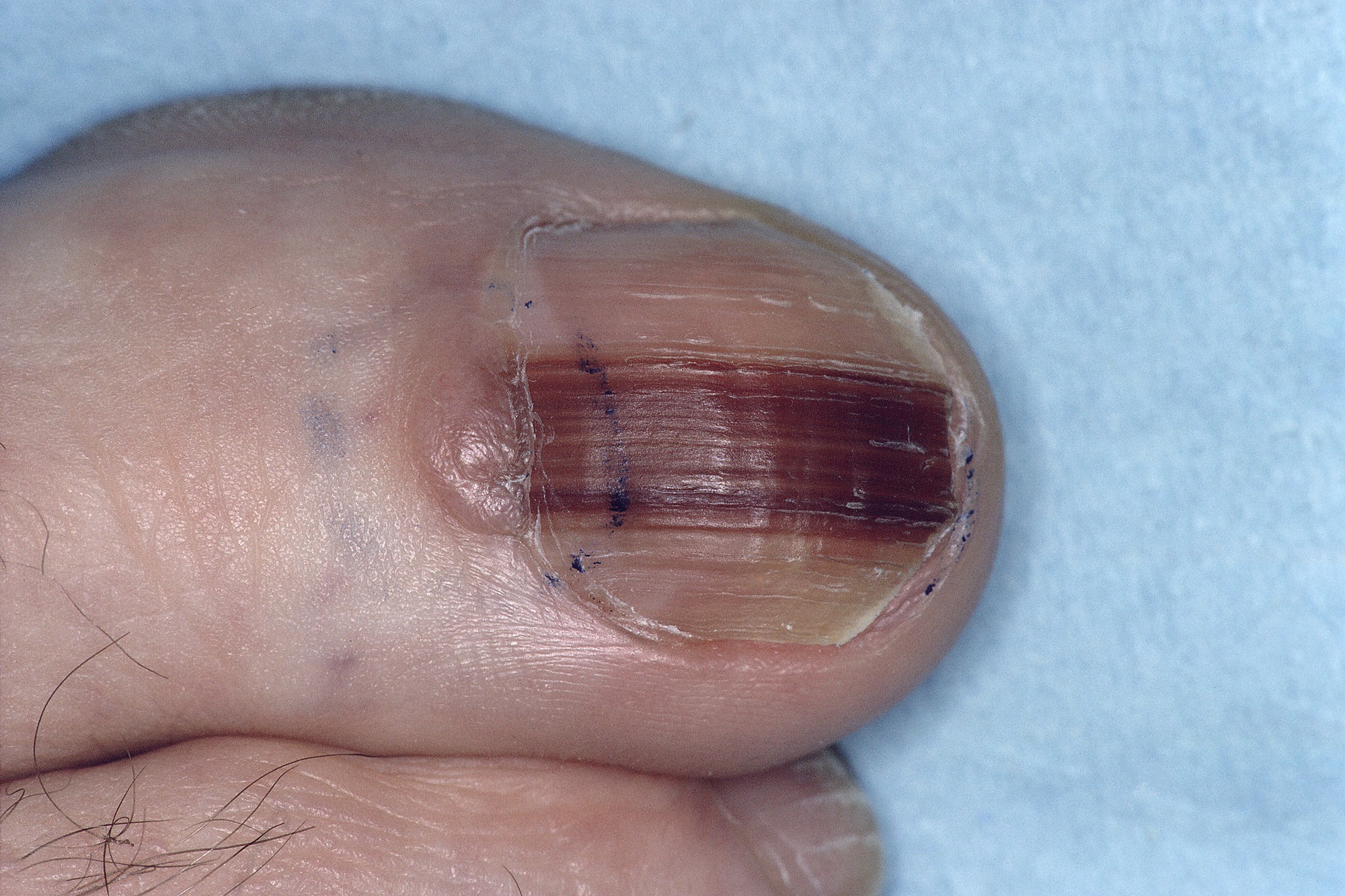 Early Identification of Nail Unit Melanoma Leads to Good ...