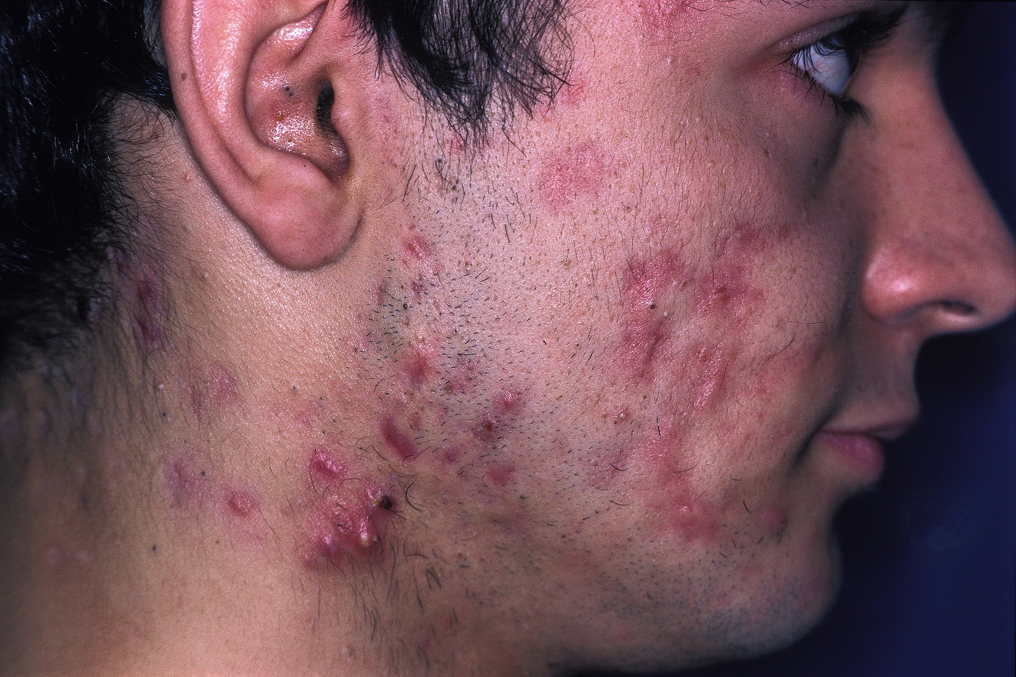 amoxicillin-therapy-effective-for-treating-inflammatory-acne