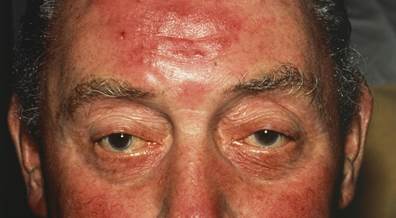 Clinical Improvement in Erythema of Rosacea With Oxymetazoline Therapy Clinical Improvement in Erythema of Rosacea With Oxymetazoline Therapy