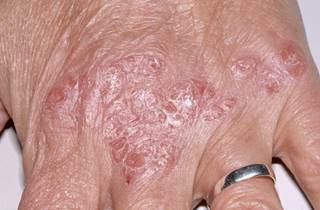 Treatment with curcumin demonstrated statistically and clinically significant improvements in psoriasis plaques. Treatment with curcumin demonstrated statistically and clinically significant improvements in psoriasis plaques.
