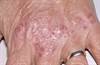 Addressing Cardiovascular Risks in Psoriasis: Guidance for Clinical Practice Addressing Cardiovascular Risks in Psoriasis: Guidance for Clinical Practice