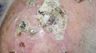 Physician Communication Linked to Improved Patient-Reported Outcomes in Actinic Keratosis Physician Communication Linked to Improved Patient-Reported Outcomes in Actinic Keratosis