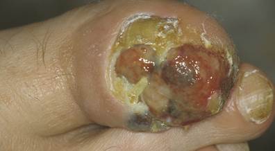 Predictive Scoring Model Effectively Differentiates Between Subungual Melanoma in <i>Situ</i>, Longitudinal Melanonychia Predictive Scoring Model Effectively Differentiates Between Subungual Melanoma in <i>Situ</i>, Longitudinal Melanonychia