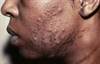 Acne in Skin of Color: Cautions for Chemical Peels Acne in Skin of Color: Cautions for Chemical Peels