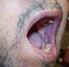 DermDx: Painful Mouth Lesions in Middle-Aged Male DermDx: Painful Mouth Lesions in Middle-Aged Male