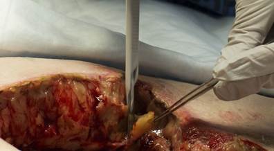 Risk for Surgical Site Infection Increased In Lower Extremity Mohs Surgery, Wide Local Excisions Risk for Surgical Site Infection Increased In Lower Extremity Mohs Surgery, Wide Local Excisions