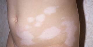 What is commonly thought of as a superficial skin disease may have autoimmune etiology that deserves to be examined further. What is commonly thought of as a superficial skin disease may have autoimmune etiology that deserves to be examined further.