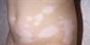 Pediatric Vitiligo: Look Beyond the Skin for Complete Treatment Pediatric Vitiligo: Look Beyond the Skin for Complete Treatment