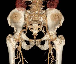 The results indicated that participants with psoriasis had a significantly higher prevalence of femoral plaques compared with control patients. The results indicated that participants with psoriasis had a significantly higher prevalence of femoral plaques compared with control patients.