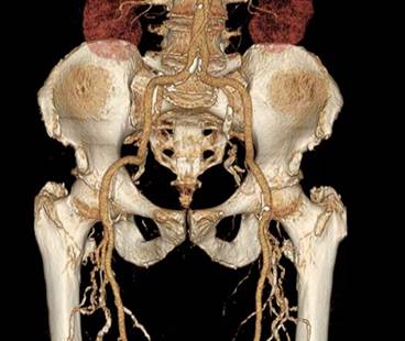 Femoral Artery Atherosclerosis More Common in Psoriasis Femoral Artery Atherosclerosis More Common in Psoriasis