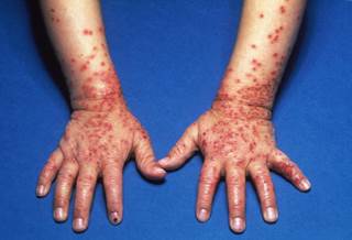 The study findings support the heavy burden that atopic dermatitis places on patients, particularly those with moderate and severe disease. <i>Credit:Medical Images RM / BOB TAPPER</i> The study findings support the heavy burden that atopic dermatitis places on patients, particularly those with moderate and severe disease. <i>Credit:Medical Images RM / BOB TAPPER</i>