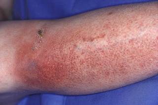 The widespread implementation of ALT-70 into clinical practice may help decrease misdiagnosis rates of lower-extremity cellulitis. The widespread implementation of ALT-70 into clinical practice may help decrease misdiagnosis rates of lower-extremity cellulitis.