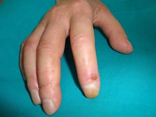 Study results suggest a strong relationship between diffuse hyperpigmentation and digital ulcers. Study results suggest a strong relationship between diffuse hyperpigmentation and digital ulcers.