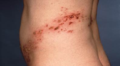 CDC Examines Safety of Recombinant Zoster Vaccine CDC Examines Safety of Recombinant Zoster Vaccine