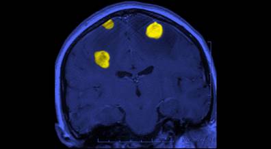 Novel Immunotherapy May Increase Survival in Melanoma With Brain Metastases Novel Immunotherapy May Increase Survival in Melanoma With Brain Metastases