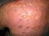 Unique Presentation of SJS in a Female Patient Treated With TMP-SMX Unique Presentation of SJS in a Female Patient Treated With TMP-SMX