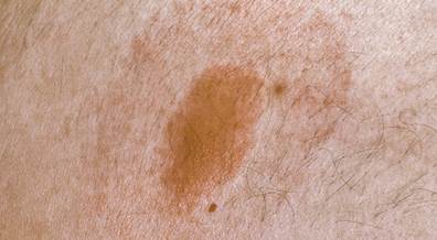 Early Disseminated, Early Localized Lyme Borreliosis Show Similar Outcomes Early Disseminated, Early Localized Lyme Borreliosis Show Similar Outcomes