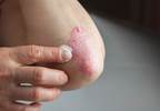 Novel Scoring System Can Up Access to Biologics in Psoriasis Novel Scoring System Can Up Access to Biologics in Psoriasis