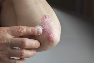 Novel Scoring System Can Up Access to Biologics in Psoriasis Novel Scoring System Can Up Access to Biologics in Psoriasis