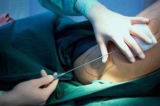 Although thought of as a minor procedure, liposuction can have severe adverse effects, including death. Although thought of as a minor procedure, liposuction can have severe adverse effects, including death.