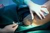 Liposuction: Reducing Complications As Well As Fat Liposuction: Reducing Complications As Well As Fat