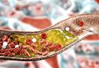 Psoriasis Associated With Clinical Signs of Accelerated Atherosclerosis Psoriasis Associated With Clinical Signs of Accelerated Atherosclerosis